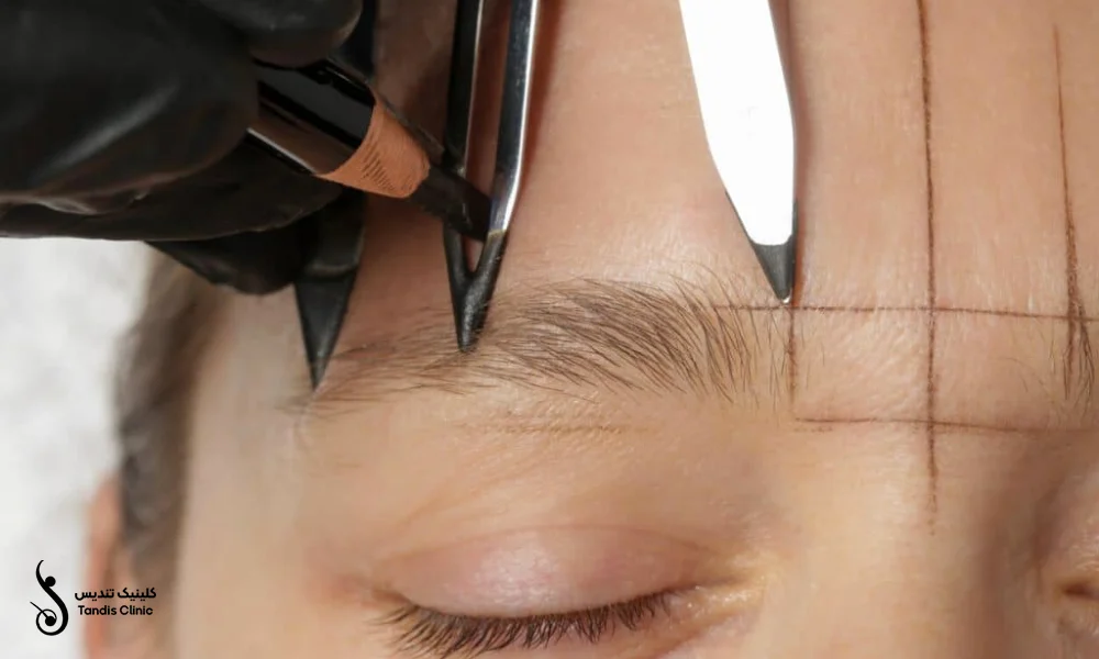 خط کشی ابروها قبل از انجام کاشت | کاشت ابرو به روش FUT