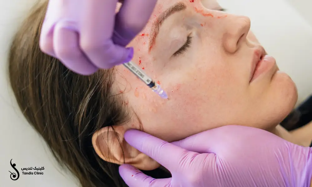 تزریق پی آر پی صورت برای خانمی که چشم هایش را بسته