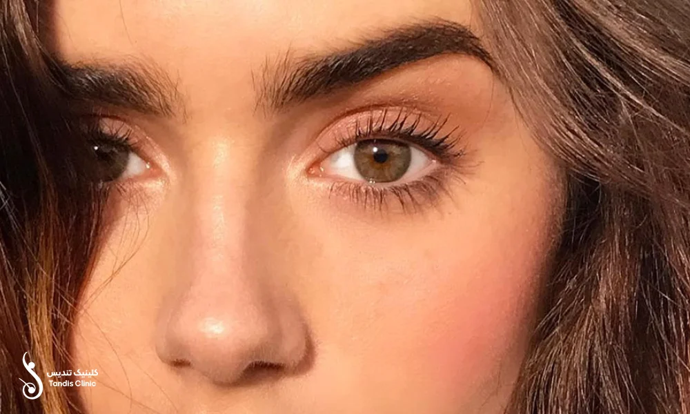 چهره ی ذختری زیبا پس از انجام کاشت ابرو به روش SUT