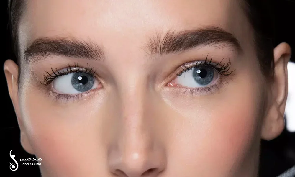 زیبایی کاشت ابرو به روش SUT