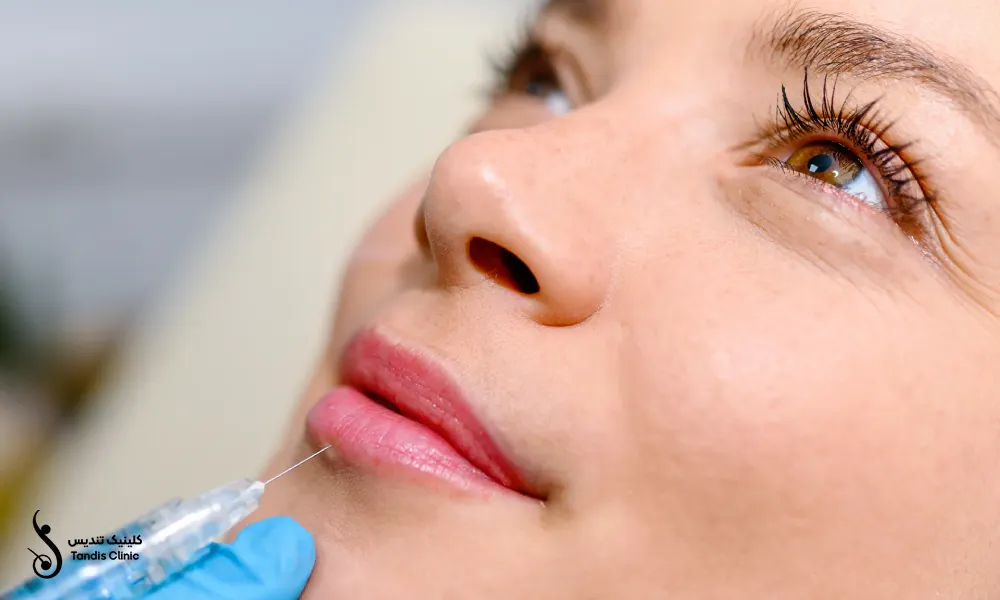 خانمی که در چهره اش رضایت از انجام تزریق فیلر لب کاملا مشخص است