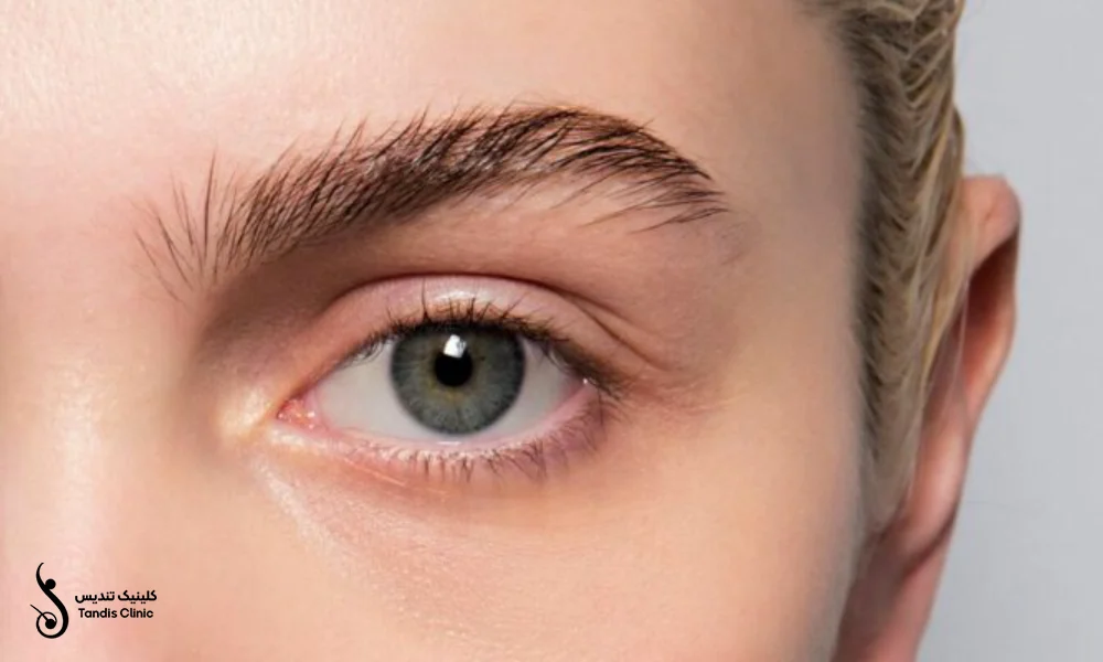 زیبایی کاشت ابرو به روش SUT