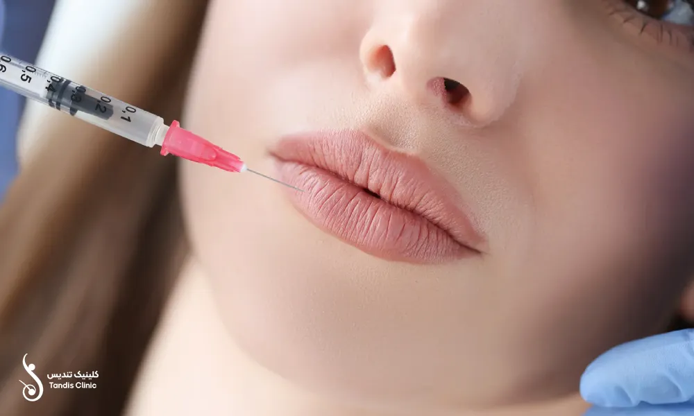 تزریق فیلر لب برای خانکی زیبا | تزریق فیلر لب