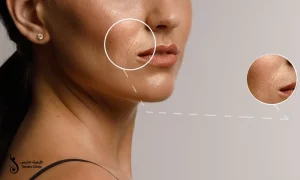 خط لبخند عمیق صورت یک خانم | فیلر خط خنده