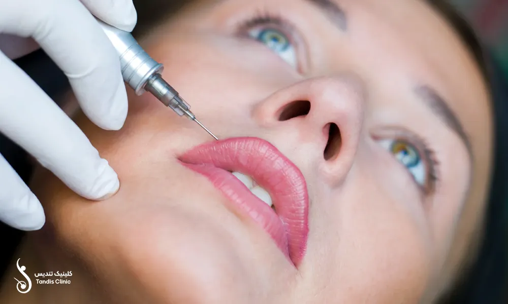 پزشکی که در حال تزریق فیلر لب برای زیباجو است