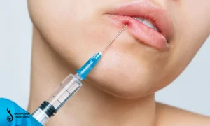 سرنگ فیلر لب قرار گرفته روی لب زیباجو | تزریق فیلر لب