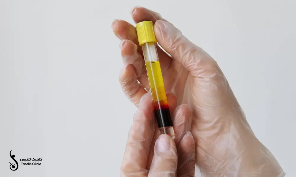 پلاسمای غنی از پلاکت در لوله های آزمایشگاه | پی آر پی دست