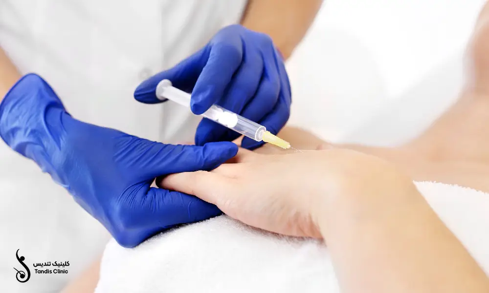 انجام پی آر پی دست برای بیمار توسط پزشک