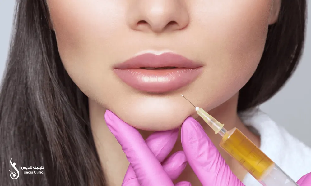 تزریق فیلر لب و تاثیر آن در زیبایی لب ها
