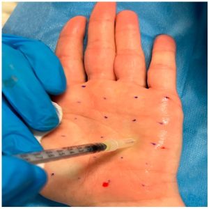 بوتاکس کف دست چیست؛ نحوه تزریق، نقاط تزریق و مزایا