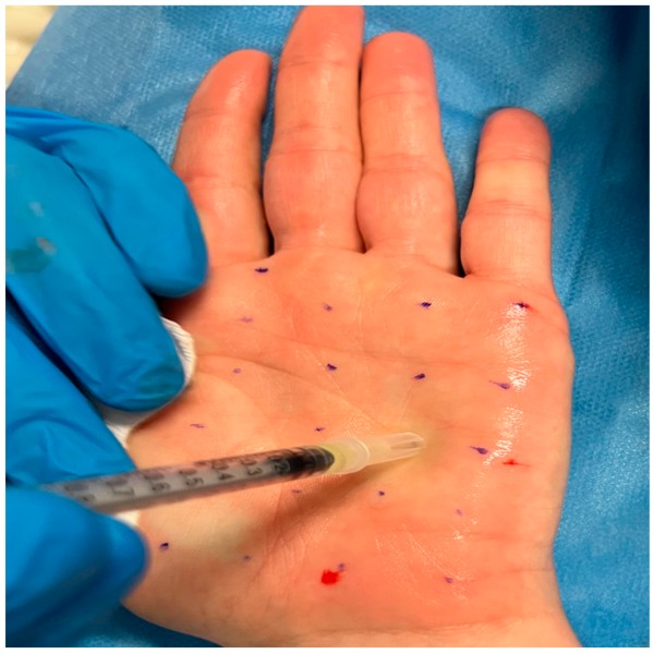 بوتاکس کف دست چیست؛ نحوه تزریق، نقاط تزریق و مزایا