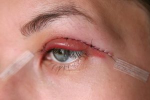 مراقبت های بعد از عمل بلفاروپلاستی