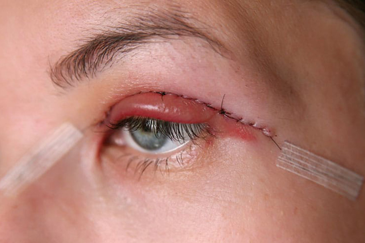 مراقبت های بعد از عمل بلفاروپلاستی