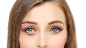 ماندگاری عمل بلفاروپلاستی