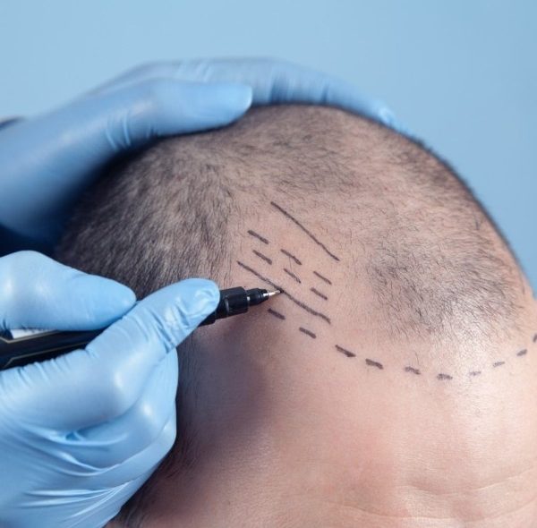 کاشت مو به روش fit چیست؛ مراقبت ها، معایب و هزینه