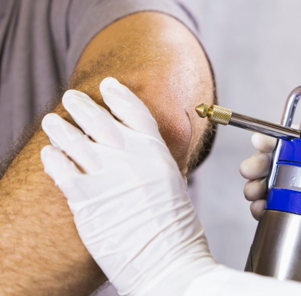 کرایوتراپی چیست؛ انواع، عوارض و هزینه