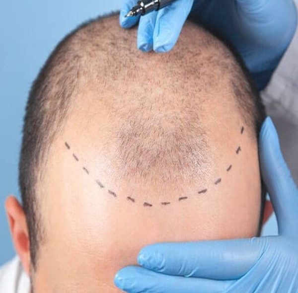 کاشت مو به روش fue چیست؛ انواع، مزایا و عوارض