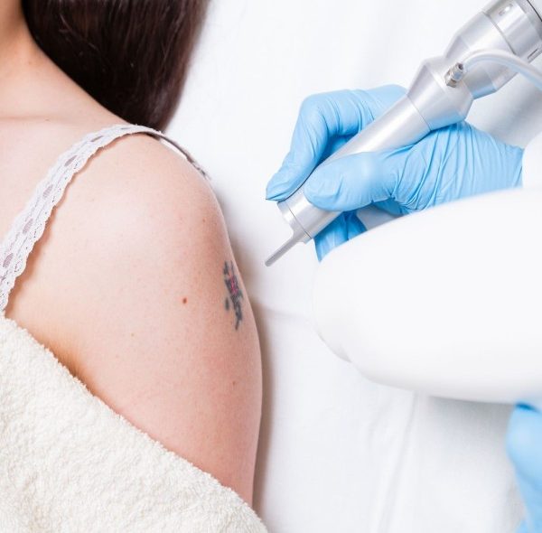 لیزر کیوسوییچ چیست؛ عوارض، هزینه و نظرات زیباجویان