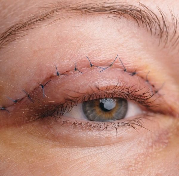 بلفاروپلاستی چیست؛ 0 تا 100 جراحی افتادگی پلک