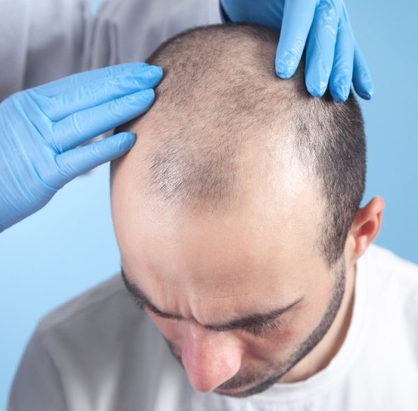 کاشت مو به روش fut چیست؛ معایب، مزایا و هزینه