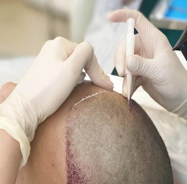 کاشت مو به روش dhi