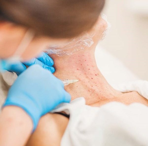 بوتاکس گردن چیست؛ کاربرد، نقاط تزریق، عوارض و ماندگاری