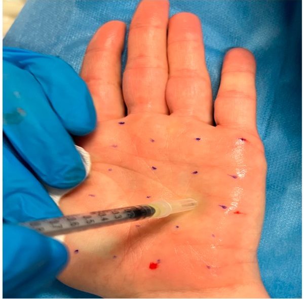 بوتاکس کف دست چیست؛ نحوه تزریق، نقاط تزریق و مزایا